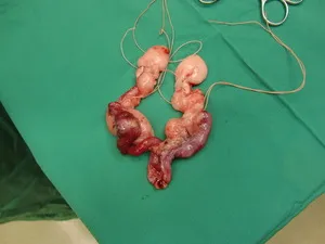 子宮内膜癌