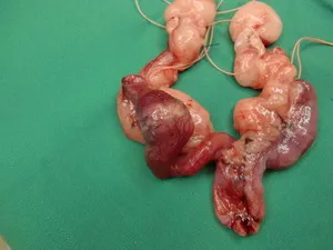 子宮内膜癌